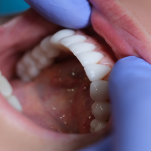 Efecto secundario del cáncer en la salud bucodental