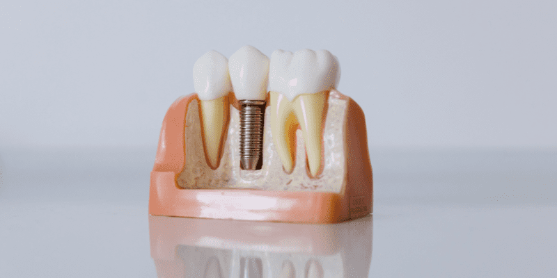 Dental implants in Almería